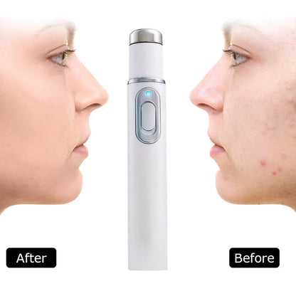 Blue Light Therapy Acne Pen Heated Eye Beauty Device Eye Massage Instrument for Dark Circles Eye Bags Puffiness Under Eyes